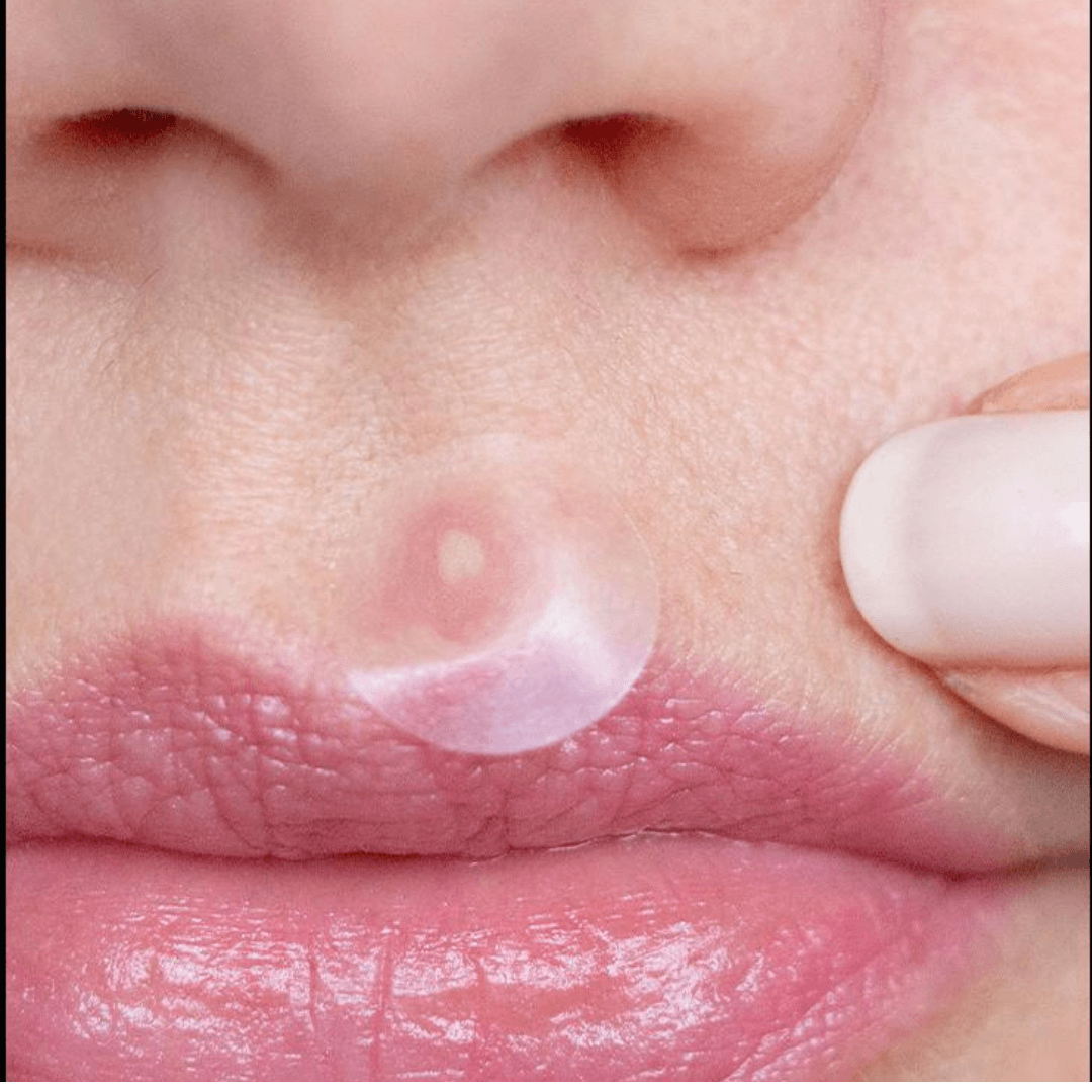 BESTSELLER - Breakout Aid- Emergency Dots